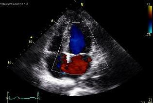 Echocardiogram(new)